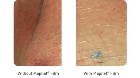 With and without Mepitel Film